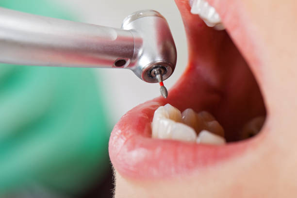 Best Emergency Tooth Extraction in Shingletown, CA